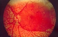  Искусственный интеллект Google DeepMind научится диагностировать заболевания, произведя анализ 1 миллиона изображений сетчатки глаза 
